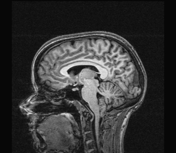 Brain